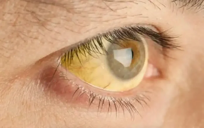 pesquisadores-desenvolvem-sensor-capaz-de-diagnosticar-febre-amarela-com-capsulas-de-cafe-recicladas