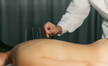 Acupuntura é regulamentada no Brasil com vetos do governo Profissional de saúde inserindo agulha de acupuntura nas costas de um paciente durante sessão de tratamento terapêutico.