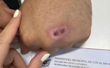 Cocal do Sul monitora caso de esporotricose humana Fotografia em close-plan aproximado mostra uma lesão cutânea circular e avermelhada no dorso da mão de um paciente, característica da esporotricose. Uma mão com luvas ou dedos de um profissional de saúde aponta para a ferida. Ao fundo, de forma nítida, aparece um documento oficial com o timbre da Prefeitura Municipal de Cocal do Sul e da Secretaria de Saúde Pública (SUS).