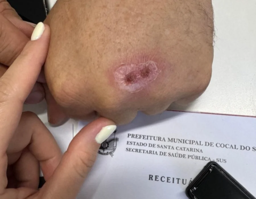 Fotografia em close-plan aproximado mostra uma lesão cutânea circular e avermelhada no dorso da mão de um paciente, característica da esporotricose. Uma mão com luvas ou dedos de um profissional de saúde aponta para a ferida. Ao fundo, de forma nítida, aparece um documento oficial com o timbre da Prefeitura Municipal de Cocal do Sul e da Secretaria de Saúde Pública (SUS).