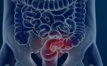 SUS avalia rastreamento de câncer colorretal