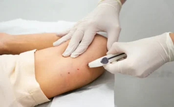 Sombrio oferece implante contraceptivo pelo SUS