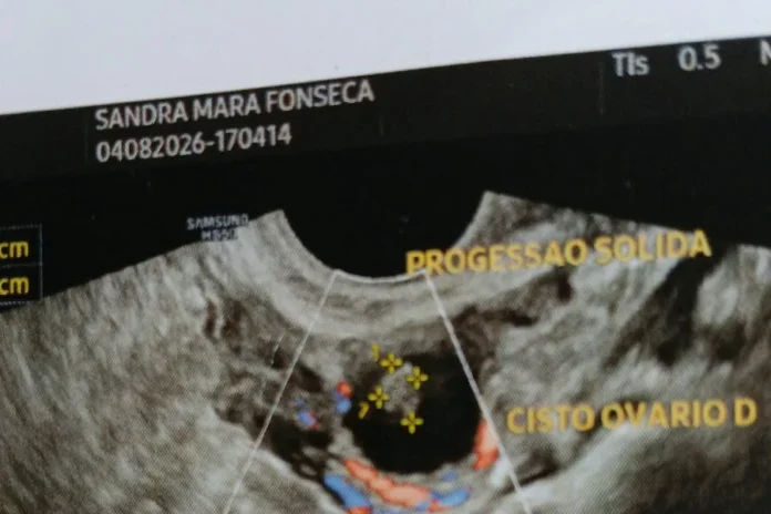foto_ultrassom_900x600 Imagem de ultrassom apresentada por Sandra durante investigação médica de cistos e alteração em ovário.