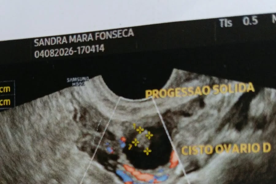 foto_ultrassom_900x600 Imagem de ultrassom apresentada por Sandra durante investigação médica de cistos e alteração em ovário.